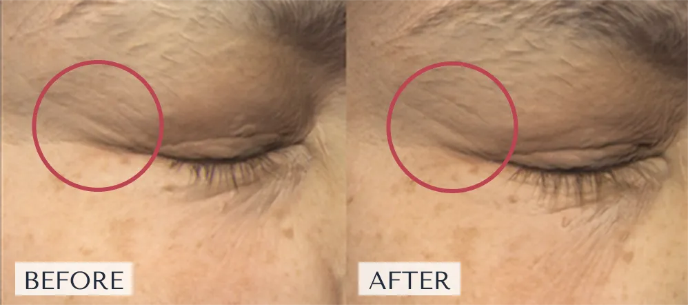 シワの深さや面積が減少